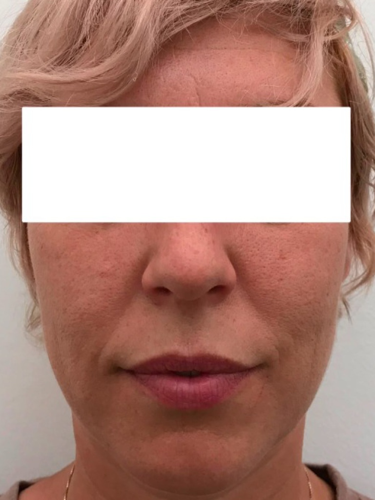 Patient 1 After Treatment