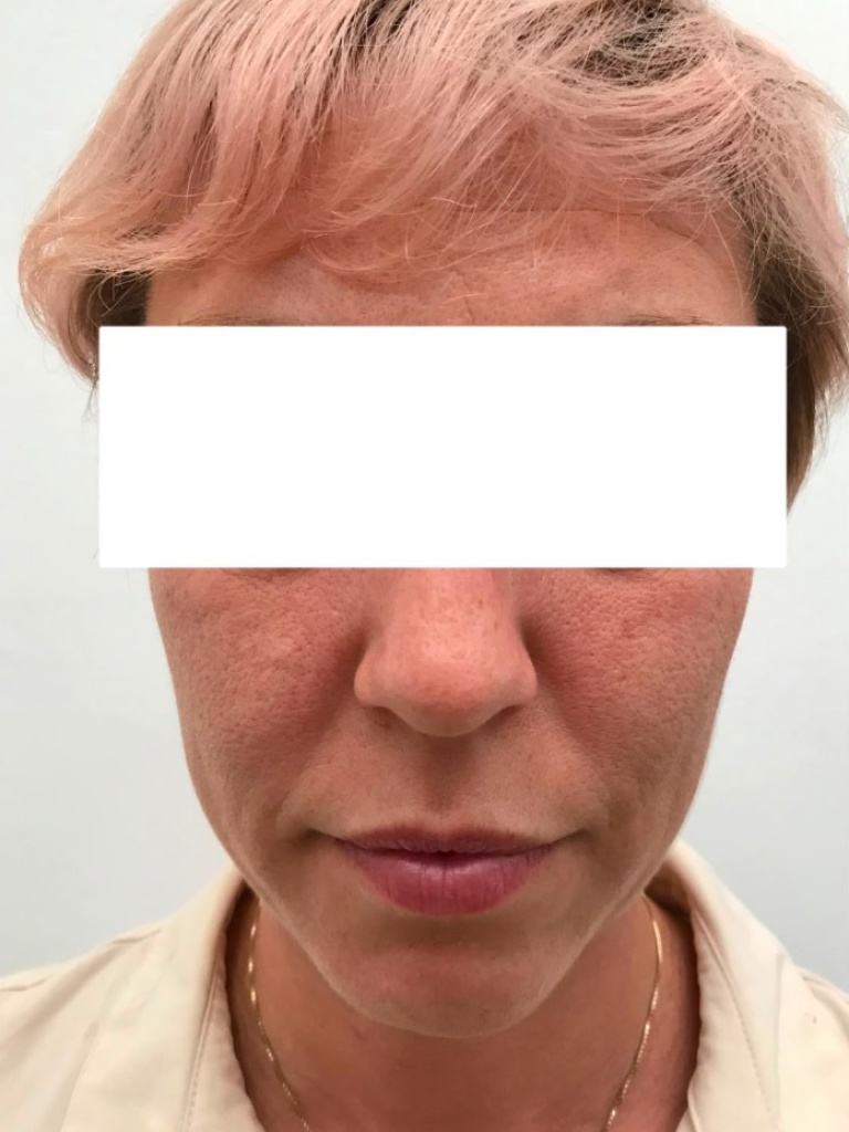 Patient 1 Before Treatment