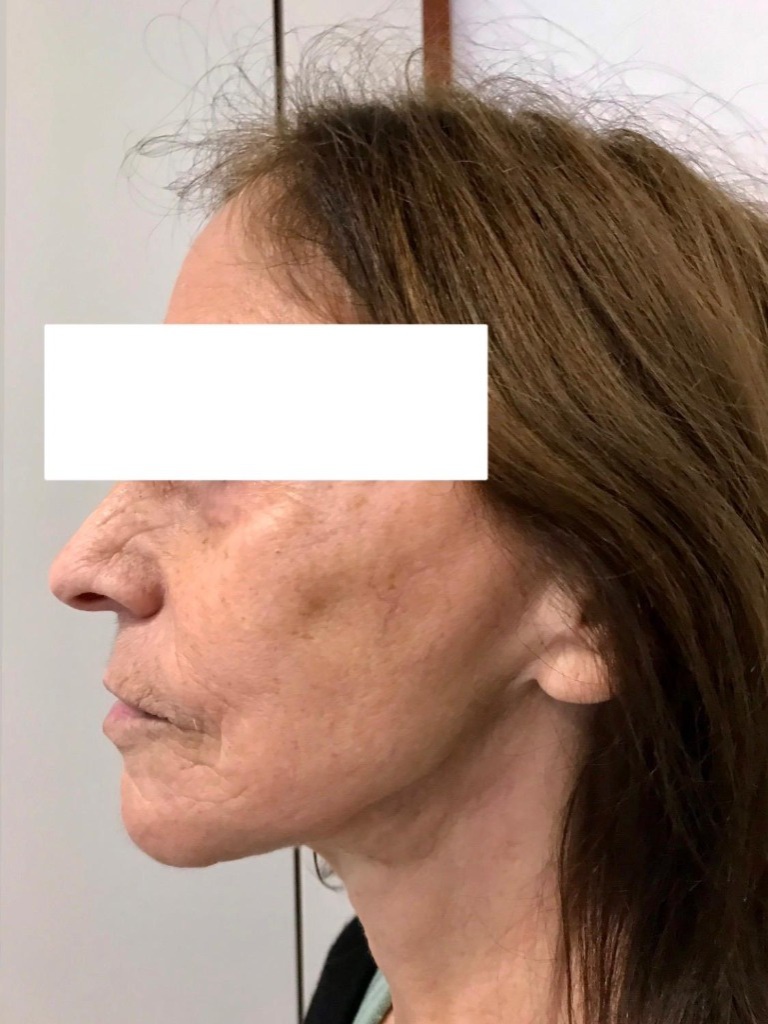 Patient 2 After Treatment