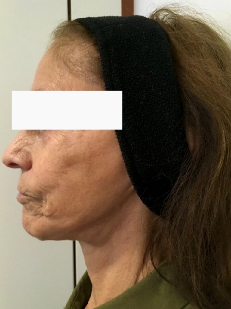 Patient 2 Before Treatment